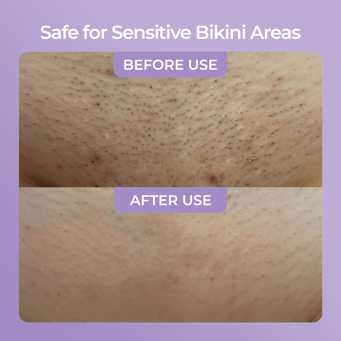Barelume Crystal™ Hair Removal Pain Free Smooth Skin